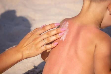 ATIENDE CLÍNICA DIF 20 CASOS DE QUEMADURAS POR EL SOL EN EL AÑO. ATIENDE CLÍNICA DIF 20 CASOS DE QUEMADURAS POR EL SOL EN EL AÑO.
