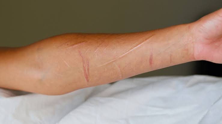 Treinta Por Ciento De Los  Menores Se Autolesionan.